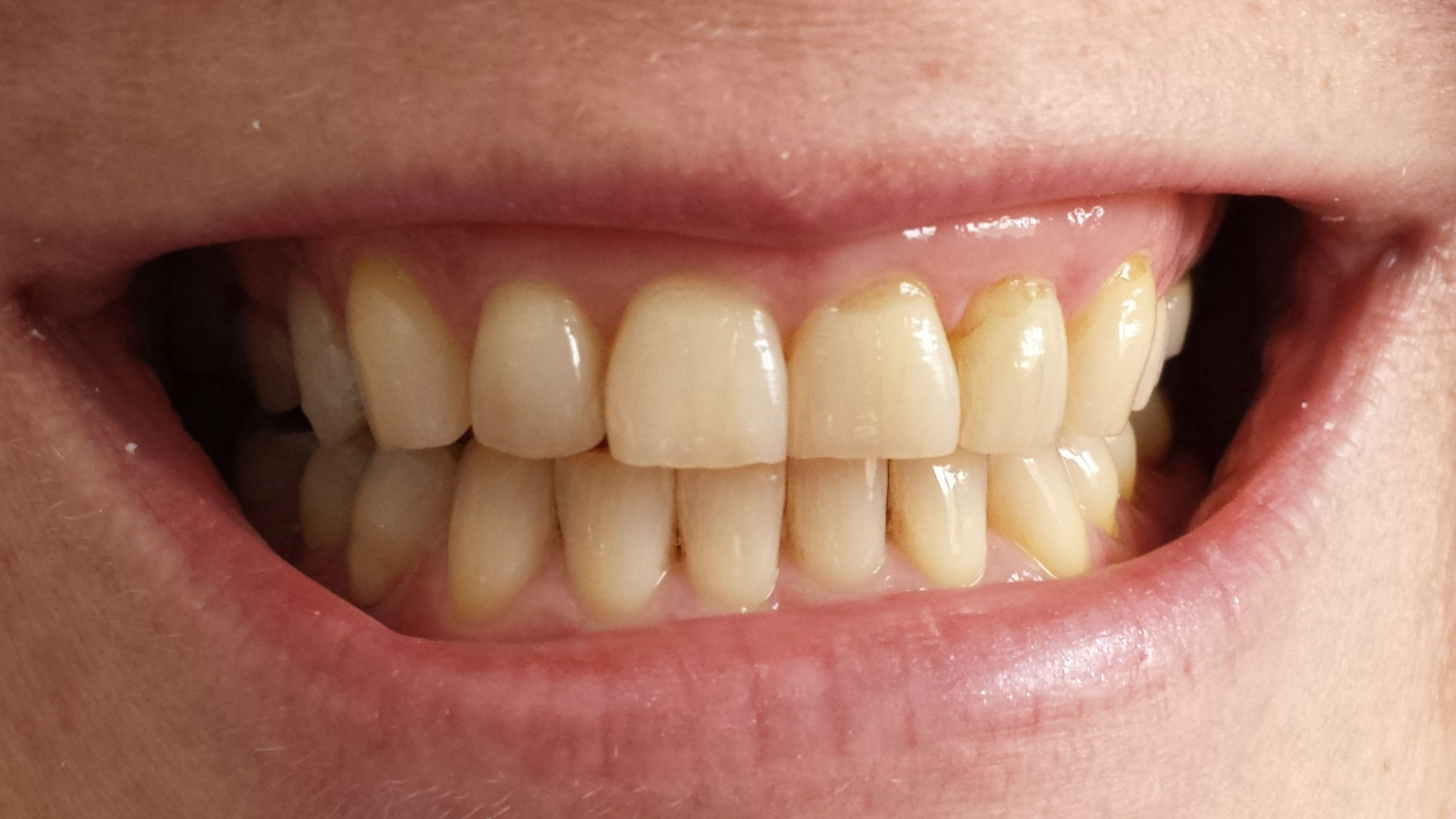 Zoom! Teeth Whitening Gallery Cherry Blossom Dentistry