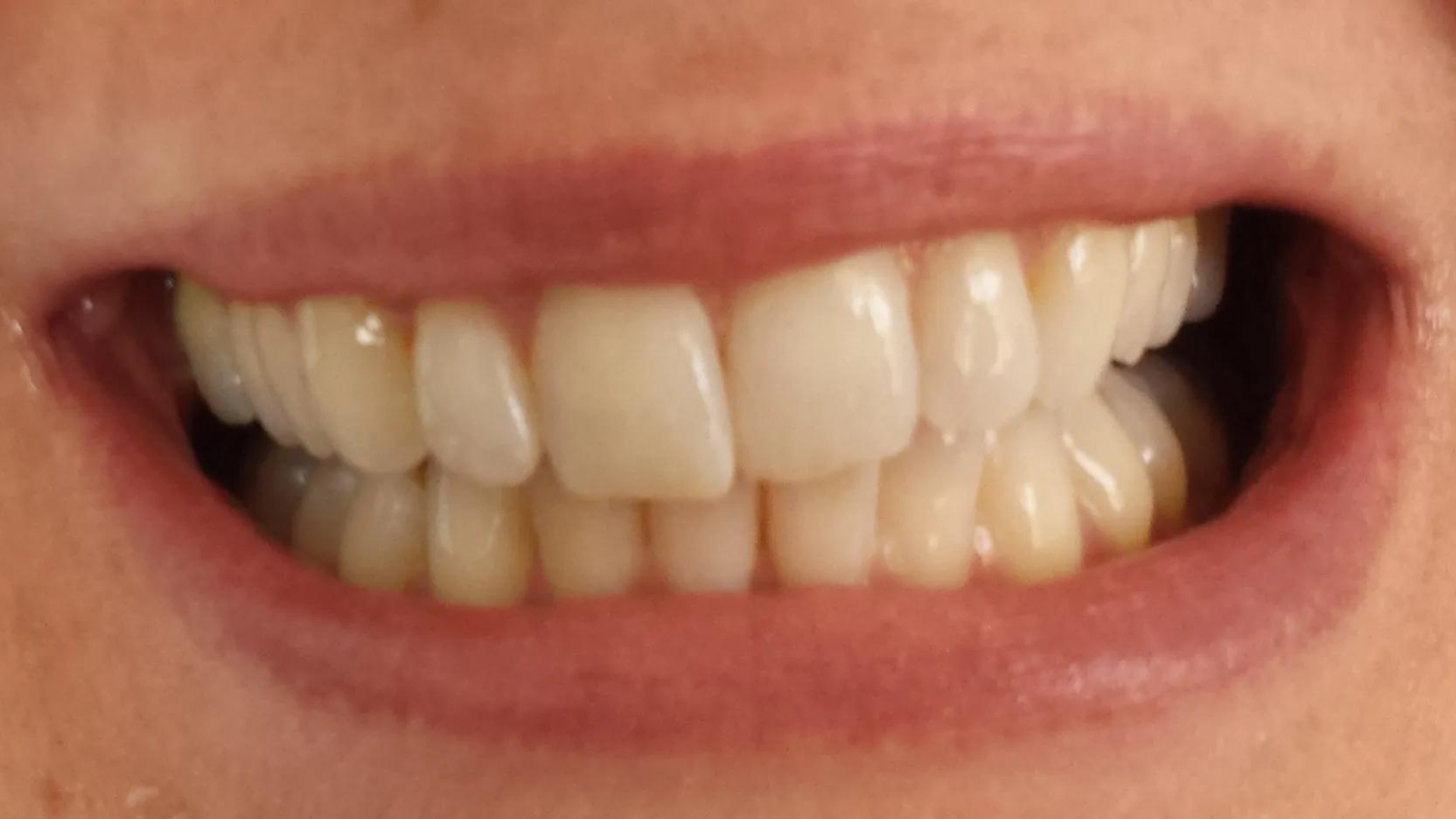 Zoom! Teeth Whitening Gallery Cherry Blossom Dentistry